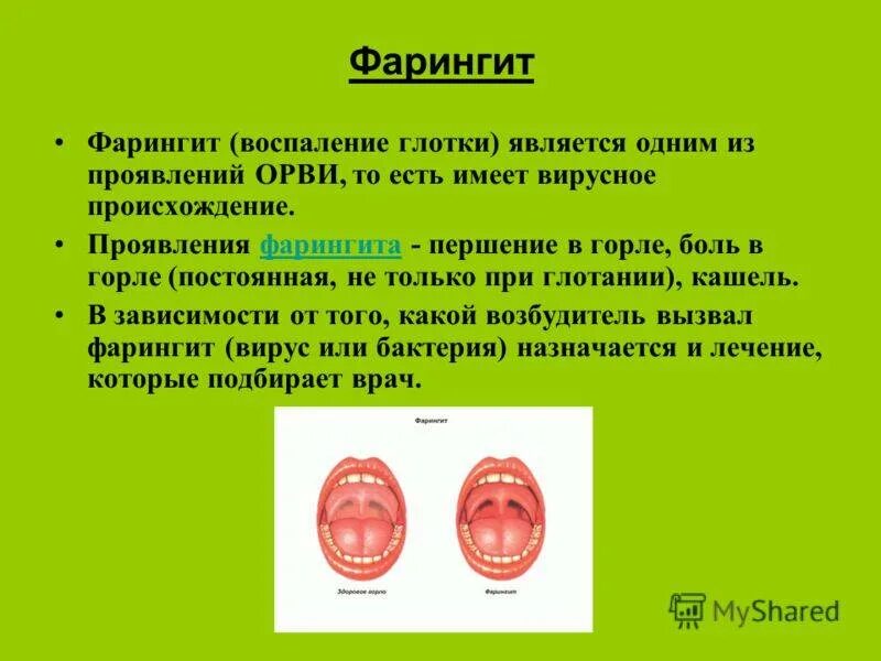 Острый фарингит лечение у взрослых симптомы фото Фарингит у детей: симптомы и лечение