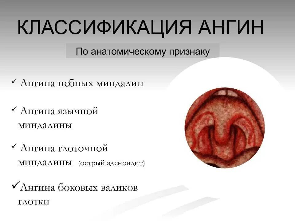 Острый фарингит лечение у взрослых симптомы фото Рините ринофарингите - найдено 88 картинок