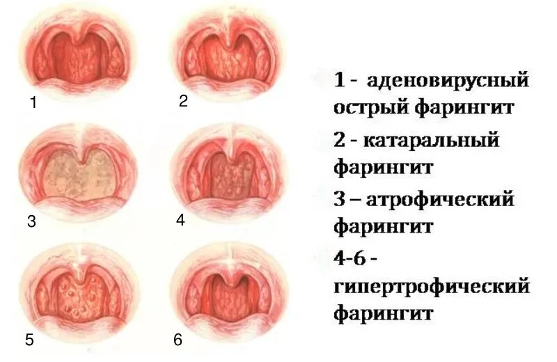 Острый тонзиллит фото горла Фарингит - симптомы и лечение в СПб
