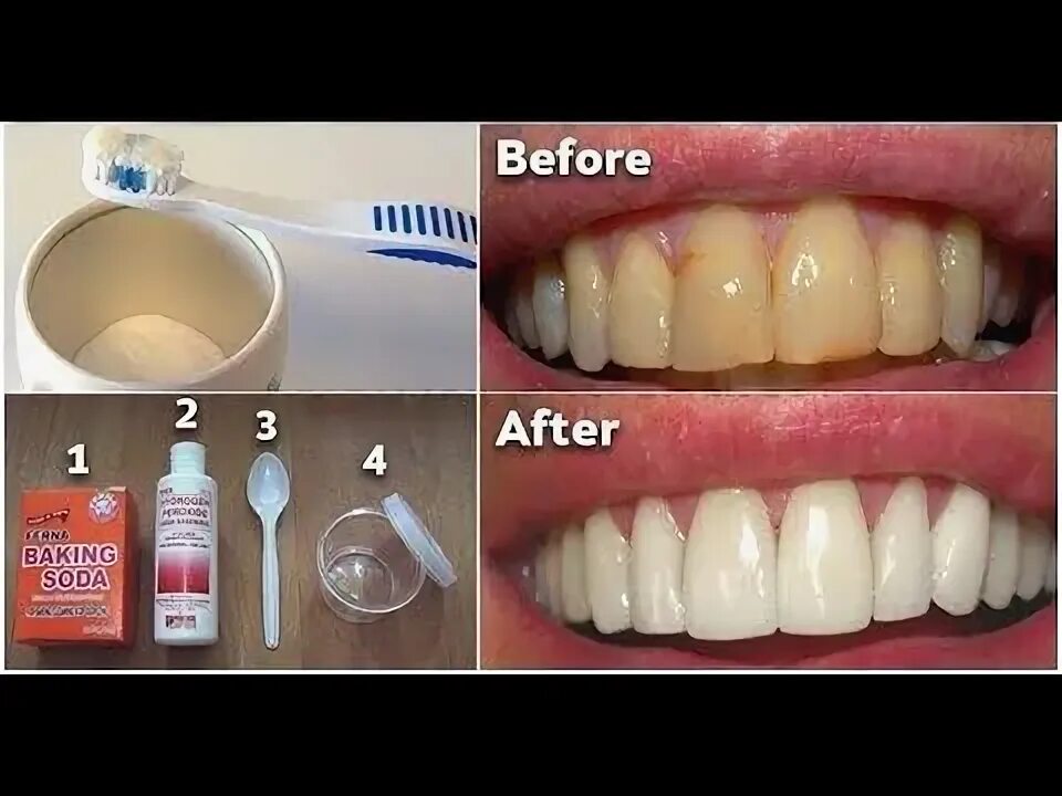 Отбелить зубы на фото Remedio para eliminar la placa dental y blanquear los dientes. Nuestra salud buc
