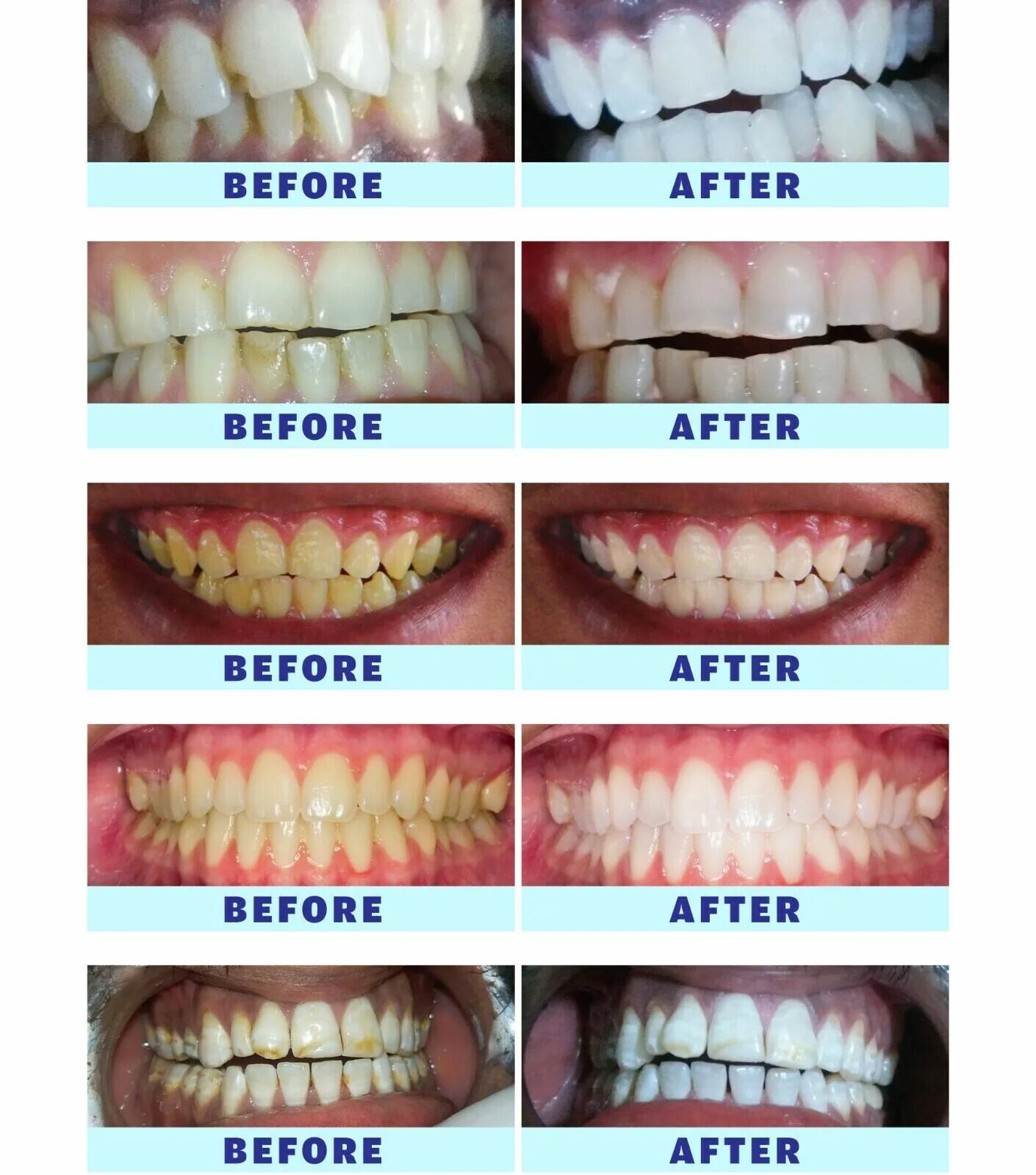Отбелить зубы на фото Blanqueador De Dientes Лазерный Гель НАБОР Профессиональный Dientes Blanqueamien