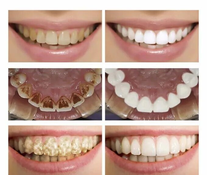 Отбелить зубы на фото онлайн бесплатно Средство отбеливания зубов Lanbena Teeth Whitening Essence LANBENA Эссенция. Зуб