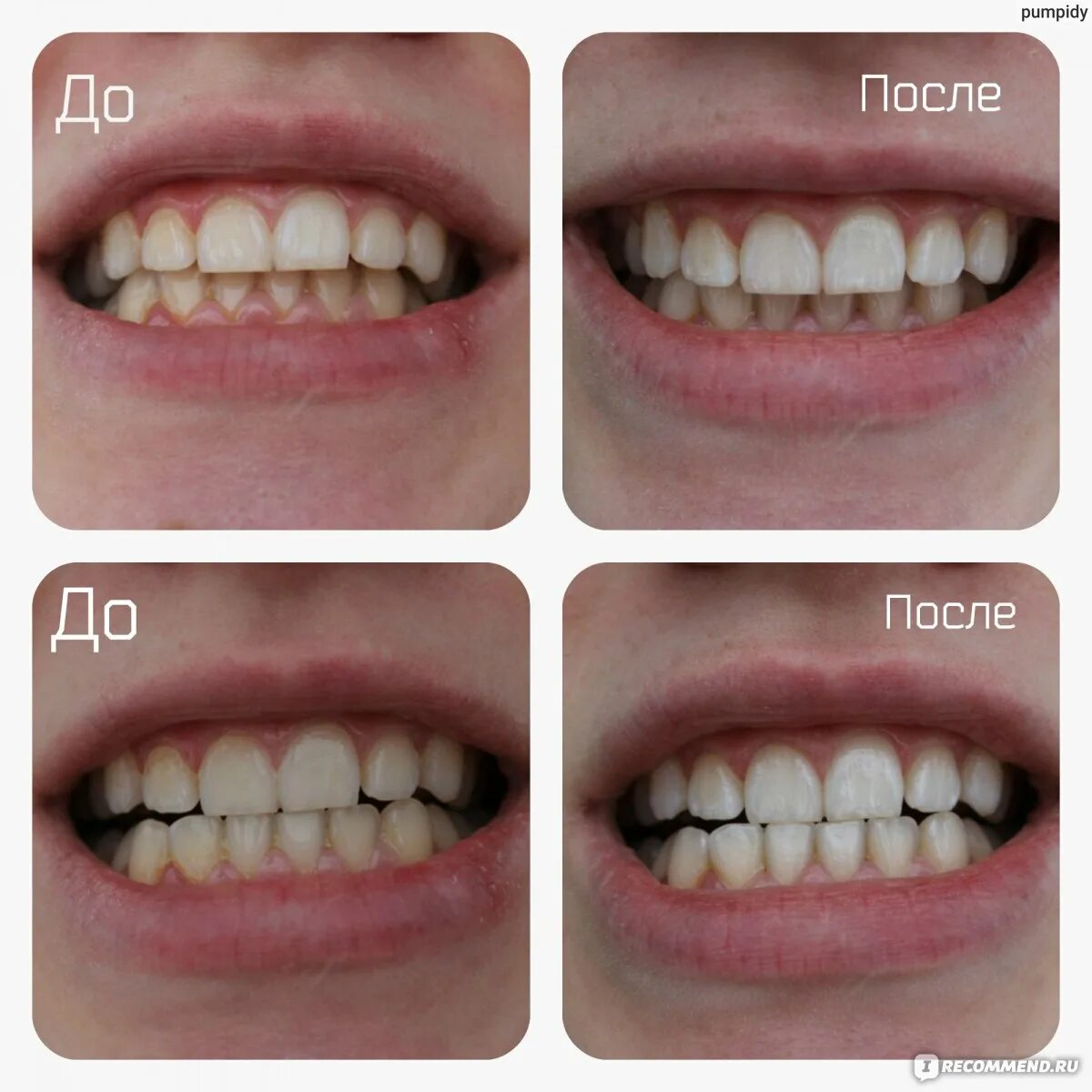 Отбеливание до и после фото Отбеливающие полоски для зубов MyBrilliantSmile На основе активированного угля и