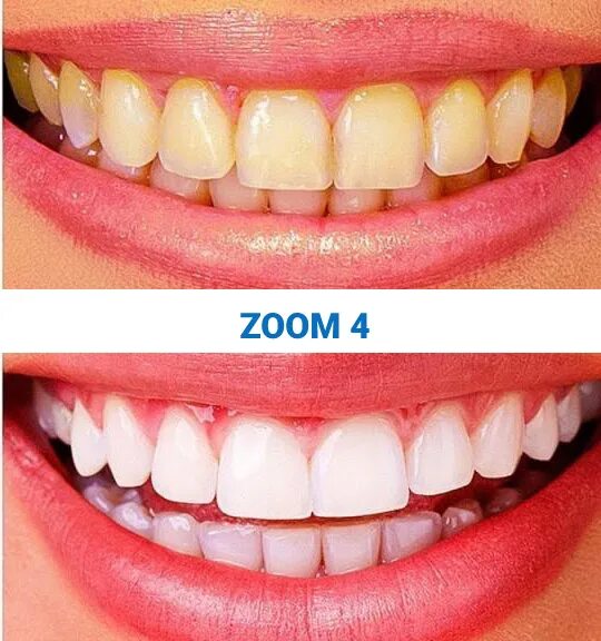 Отбеливание до и после фото Отбеливание зубов zoom 3 и zoom 4 Дента Смайл