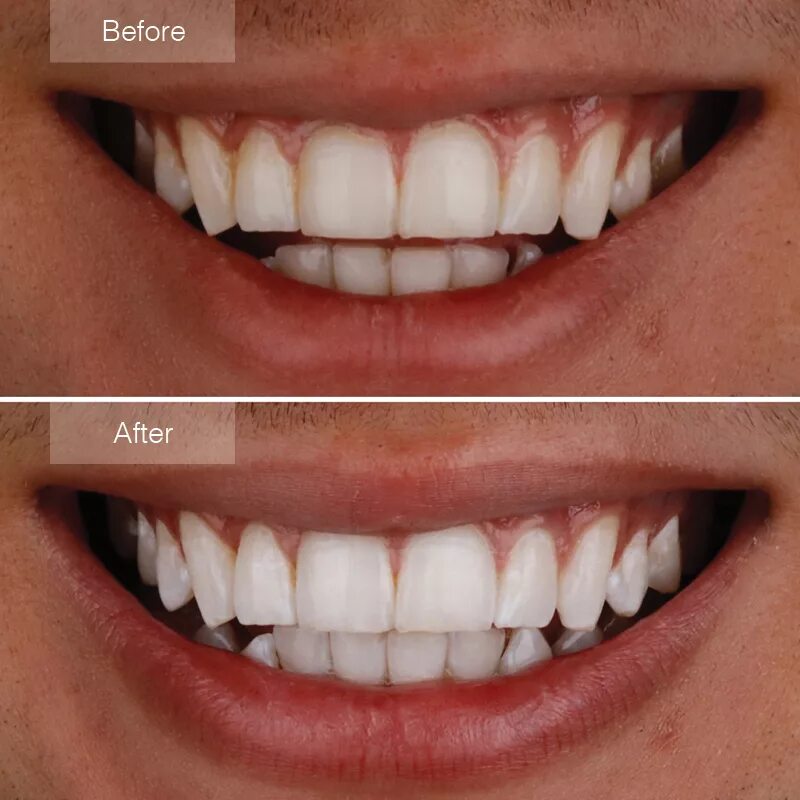 Отбеливание до и после фото Edited Photo With Teeth Whitener But It Didn't Work on Sale veter-komforta.ru