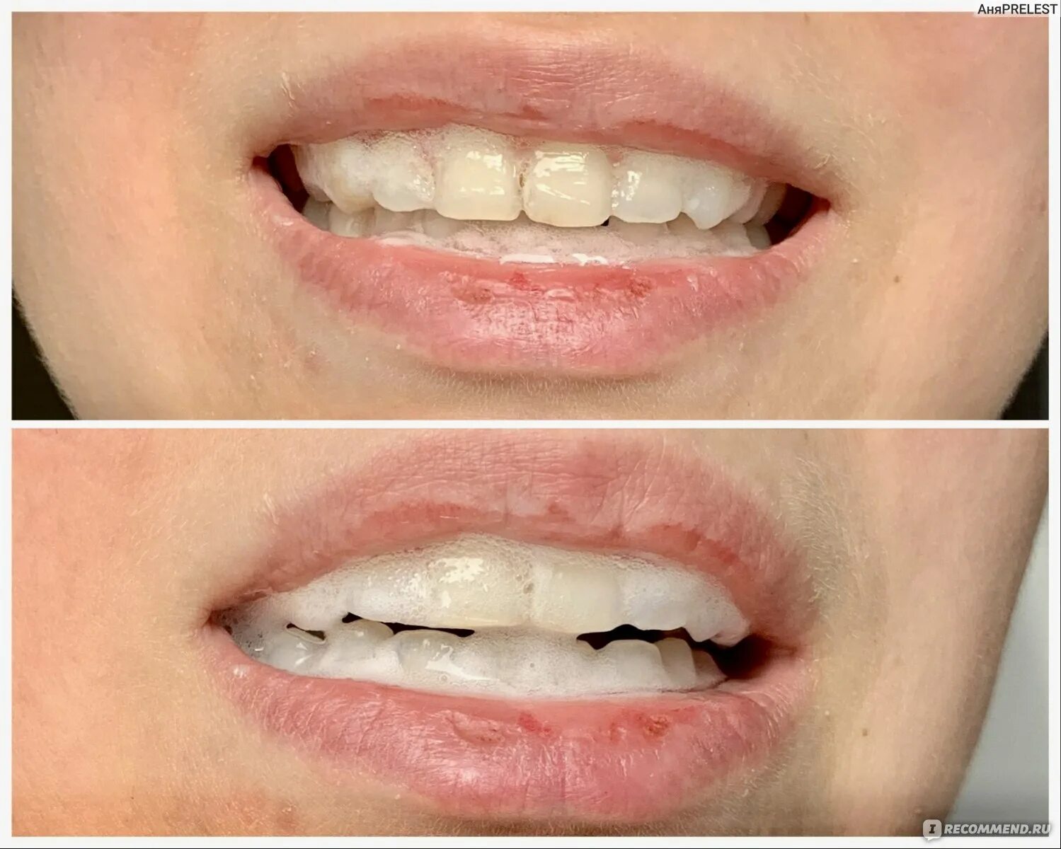 Отбеливание до и после фото Карандаш для отбеливания зубов Dr.care "Belle Whitening 6%" - "Хороший вариант д