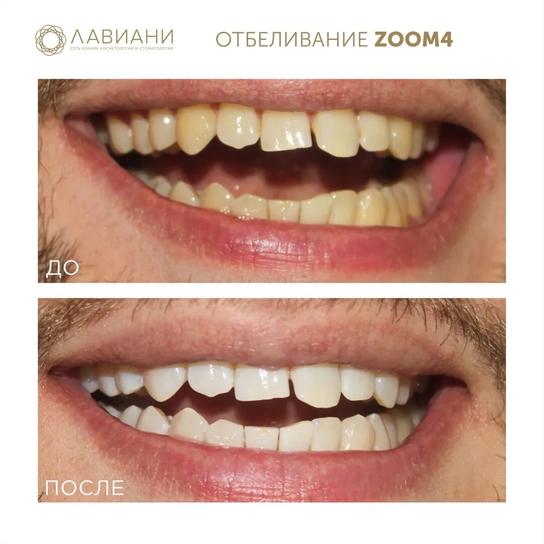 Отбеливание до и после фото реальные Zoom отзывы фото YugNash.ru