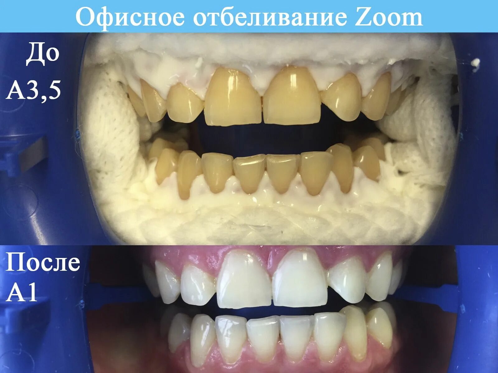 Отбеливание до и после фото реальные Отбеливание Zoom Superhero logos