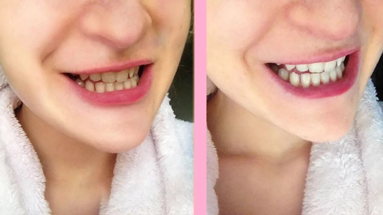 Отбеливание до и после фото реальные Crest white strips honest review - YouTube