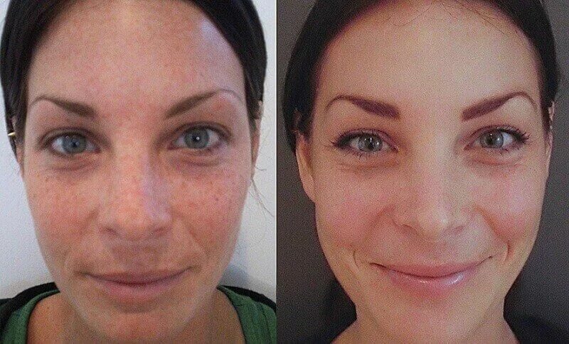Отбеливание лица до и после фото Azelaic Acid in Skin Care: How It Works, Best Products and Use Chemical skin pee