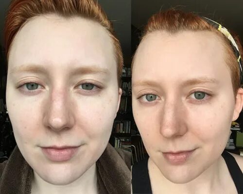 Отбеливание лица до и после фото baking soda face scrub for blackheads Online Shopping