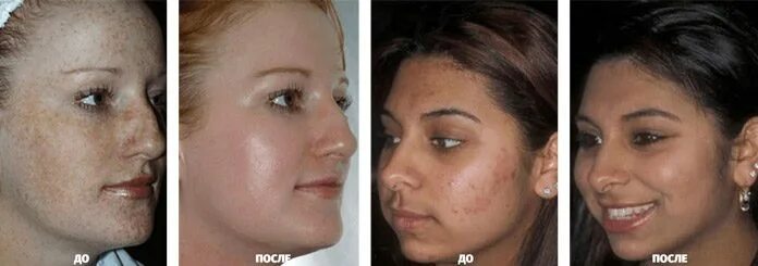 Отбеливание лица до и после фото Постпилинговый уход после пилинга Джесснера - все тонкости. Пилинг Джесснера - к