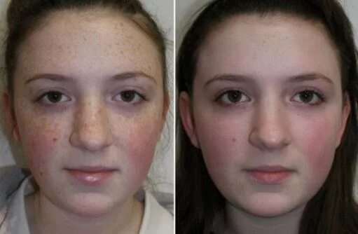 Отбеливание лица до и после фото Pin on Face Peels Before and Afters