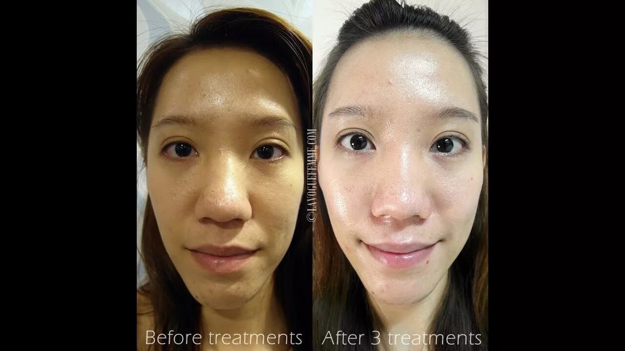 Отбеливание лица до и после фото Unbelievable Results 100 % skin whitening treatment Get permanant fair skin a - 