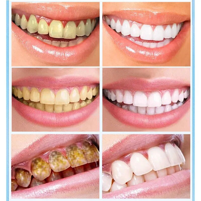Отбеливание зубов фото Effective Teeth Whitening Pen Tooth Whitener Tea Coffee Stain Remove Teeth Care 