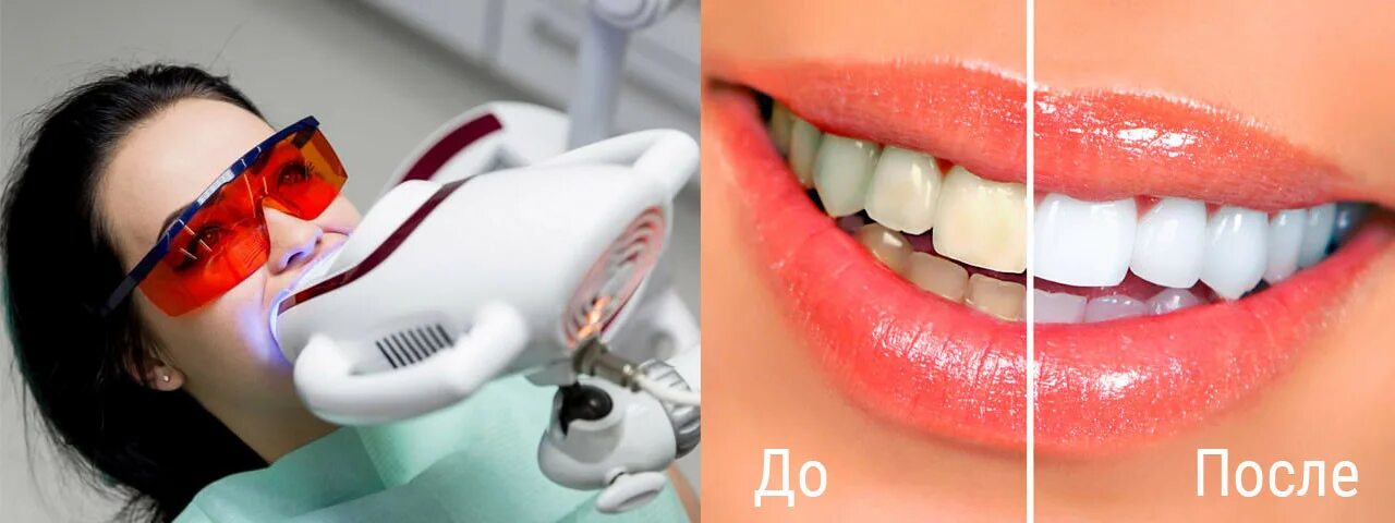 Отбеливание зубов фото Лечение среднего кариеса в медицинских центрах на улице Шостаковича - Санкт-Пете