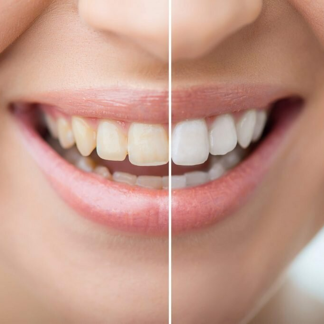 Отбеливание зубов фото Dental Clinic Smile, dental clinics, Чебоксары, Пролетарская улица, 16, корп. 2 