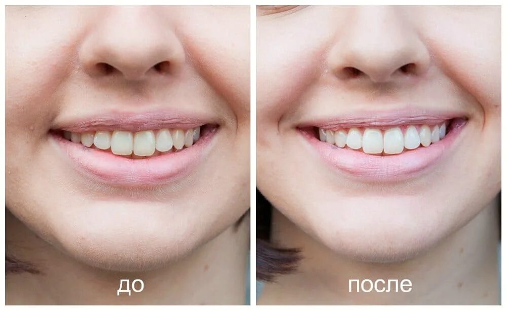 Отбеливание зубов реальные фото Отбеливание зубов Одинцово "Меди-Профи"