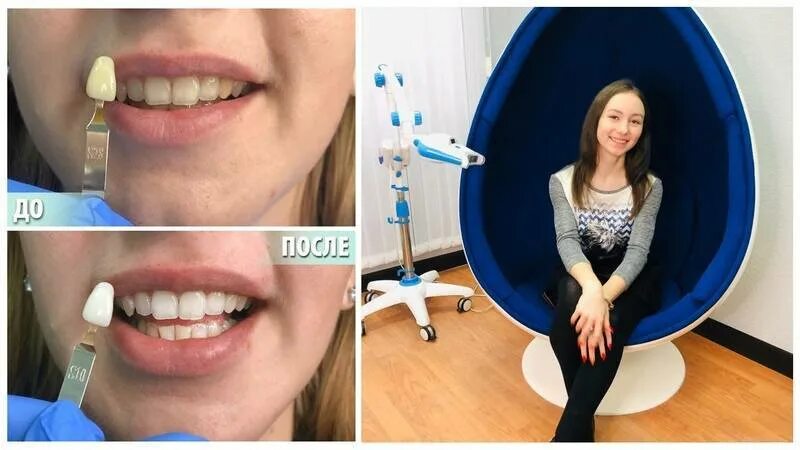 Отбеливание зубов реальные фото White отбеливание зубов, преимущества и недостатки процедуры