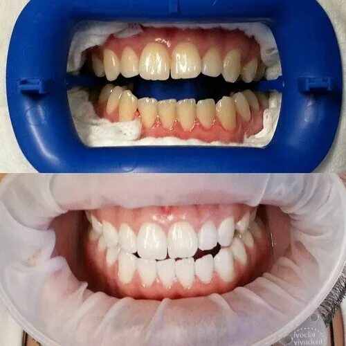 Отбеливание зубов zoom фото Prices at Dental Zar in - Yandex Maps