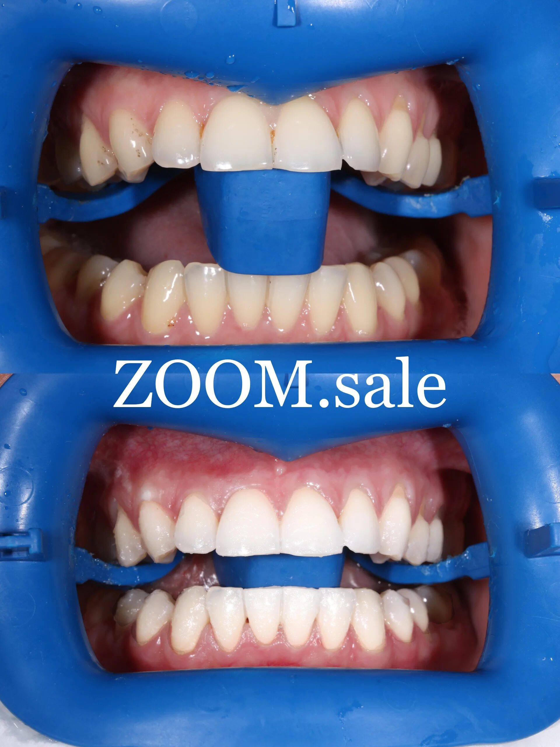 Отбеливание зубов zoom фото Отбеливание зубов Zoom 4 в Москве за 14500р. - отзывы, цена, акции и скидки