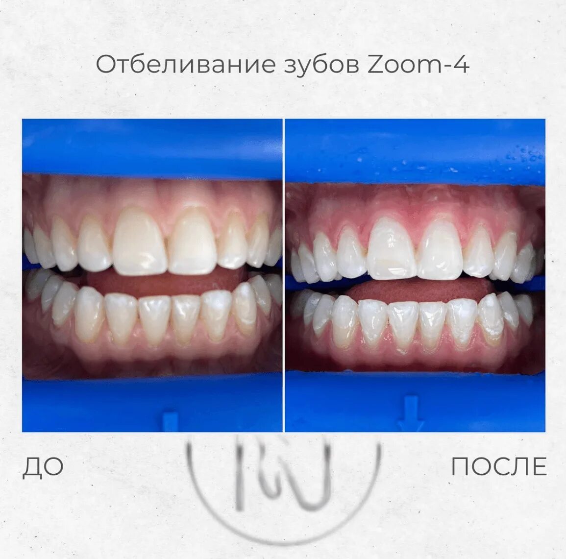 Отбеливание зубов zoom фото Отбеливание кемерово