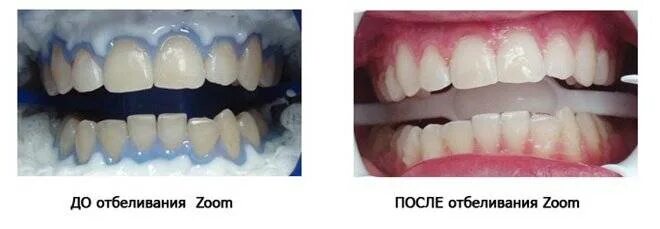 Отбеливание зубов зум фото Zoom отбеливание зубов, преимущества и недостатки процедуры
