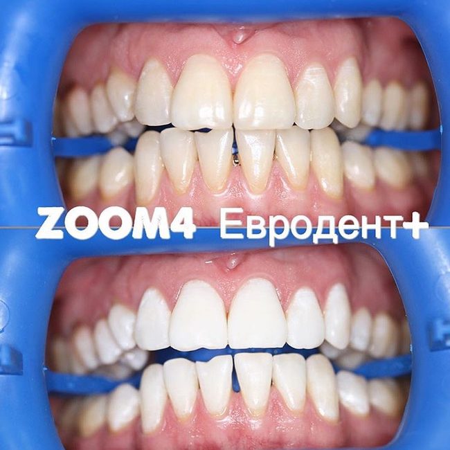 Отбеливание зубов зум фото Yevrodent+, dental clinics, Rostov-on-Don, Zhuravlyova Lane, 166 - Yandex Maps