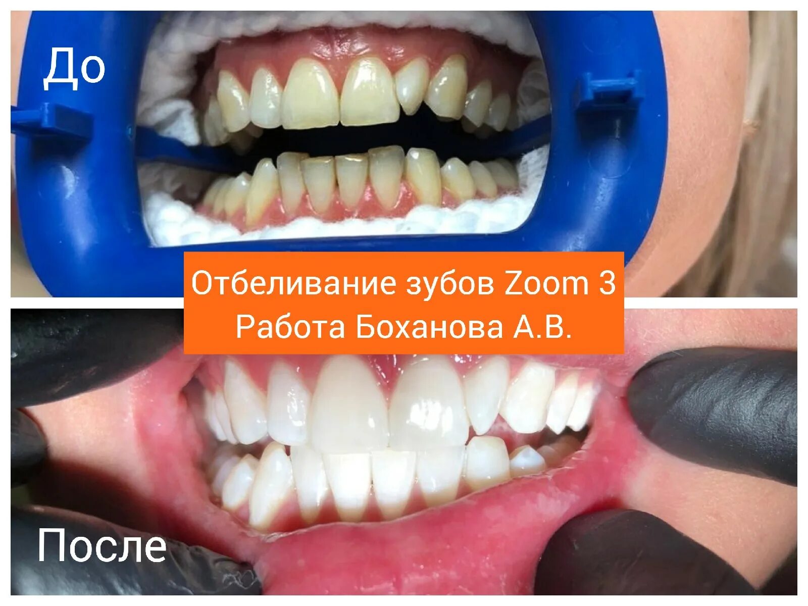 Отбеливание зубов зум фото Красивые зубки Санкт-Петербург - телефон, адрес, контакты. Отзывы о Красивые зуб