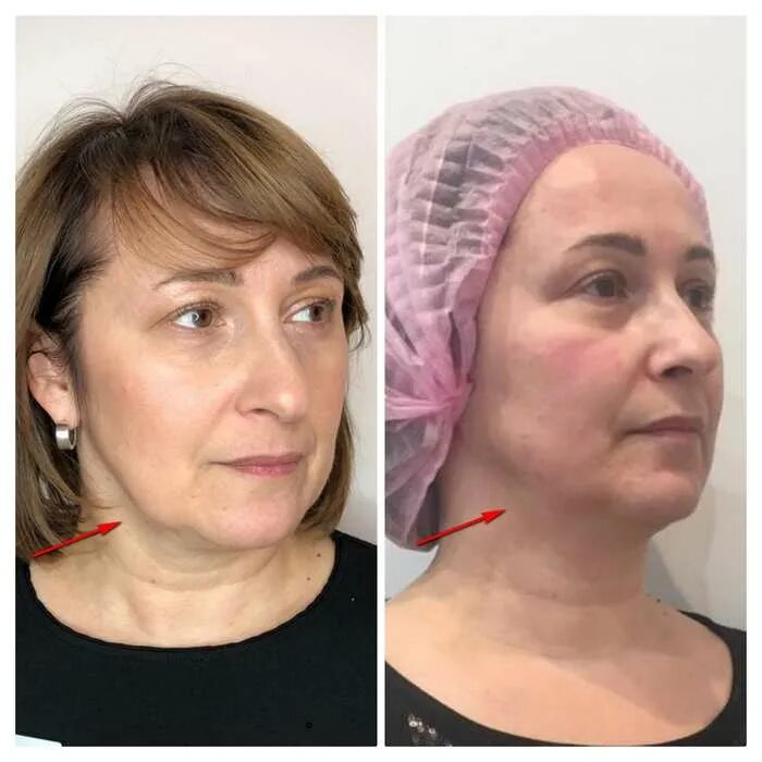 Отзывы после смас лифтинг лица фото Центр смас лифтинга