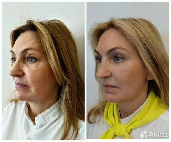 Отзывы после смас лифтинг лица фото Приглашаем моделей на ультраформер в Москве Услуги Авито