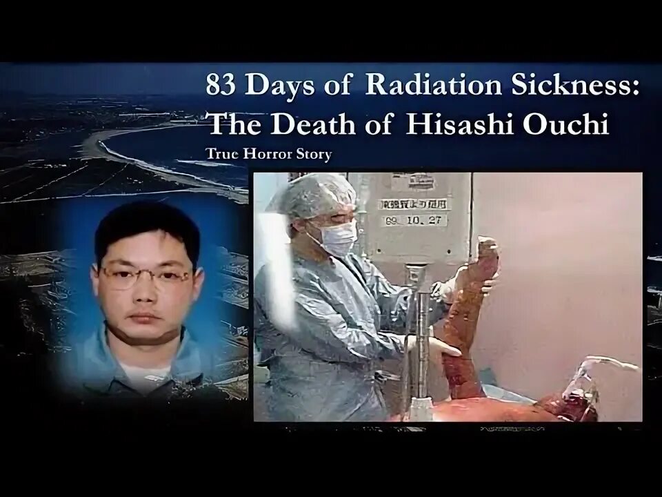 Оучи радиация фото в больнице 83 Days of Radiation Sickness: The Death of Hisashi Ouchi True Horror Sto