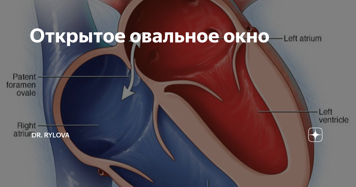 Овальное окно в сердце фото Операция открытого овального окна: найдено 85 изображений