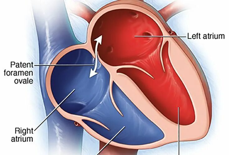 Овальное окно в сердце фото 40% HAVE A PFO (PATENT FORAMEN OVALE) - DO YOU? Nurse teaching, Medical, Heart h