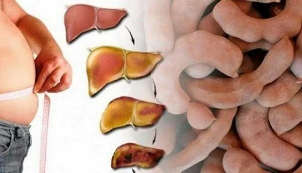 Ожирение печени фото Apprenez à utiliser le bicarbonate de soude pour que vos toilettes sentent toujo
