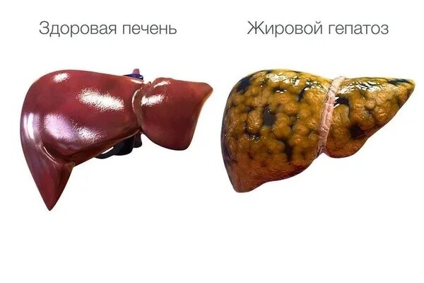 Ожирение печени фото Жировой гепатоз печени: что это такое, симптомы и лечение