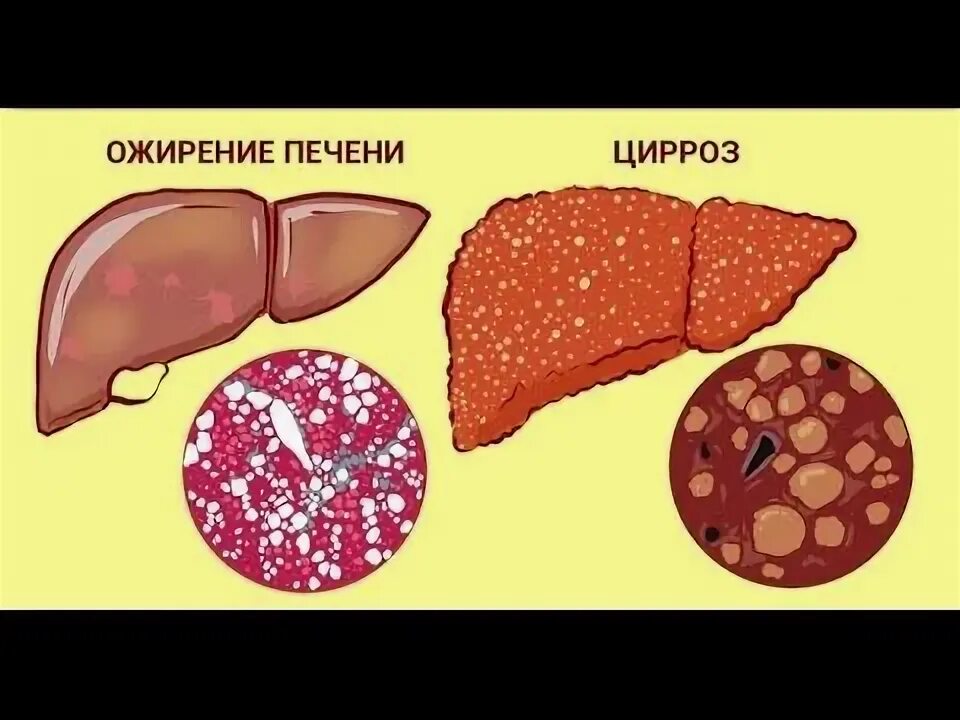 Ожирение печени фото 5 МАГИЧЕСКИХ РЕЦЕПТОВ ИЗ ТРАВ ДЛЯ ПЕЧЕНИ! Здоровье, Товары для здоровья