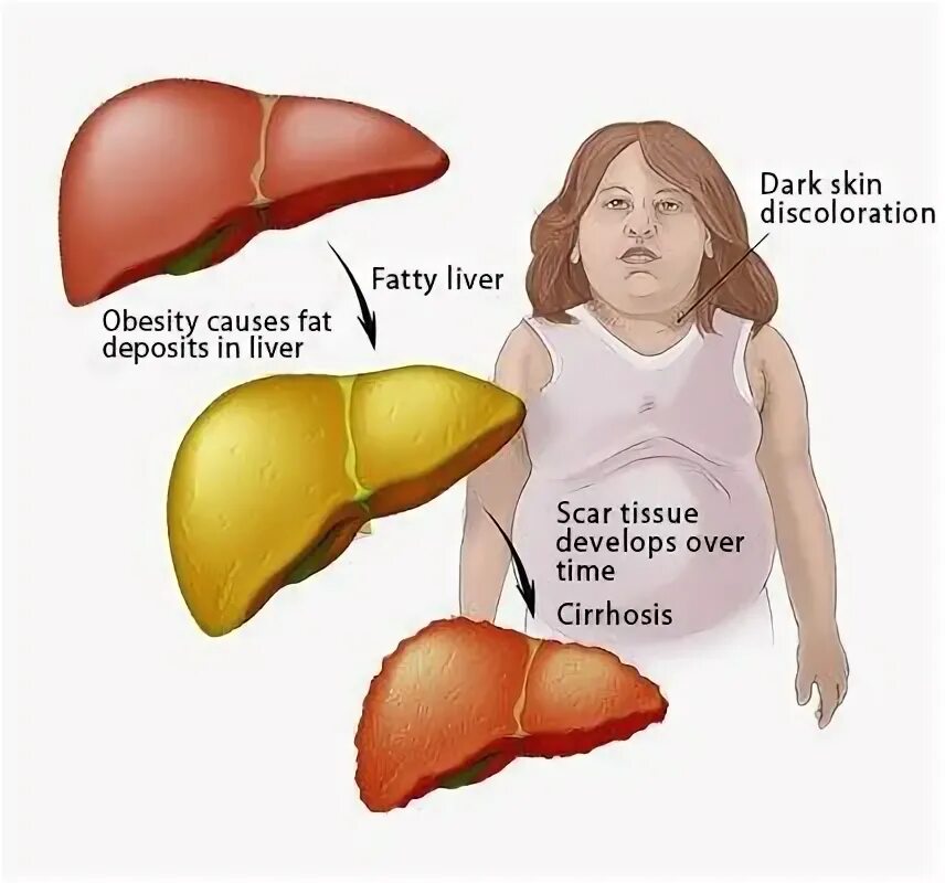 Ожирение печени фото The Recipe Doctors Will Not Tell You: Your Liver Will Be Like A New And You Will