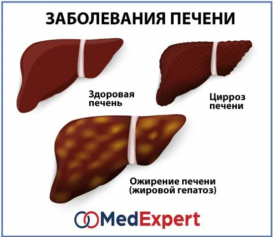 Ожирение печени фото Жировой гепатоз и цирроз печени vs. здоровая печень Печенье, Пузыри