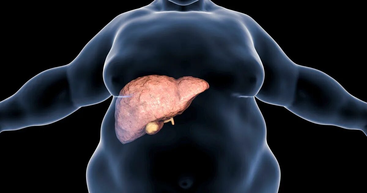 Ожирение печени фото Fatty liver disease: Common problem could be symptom of crippling condition - Mi