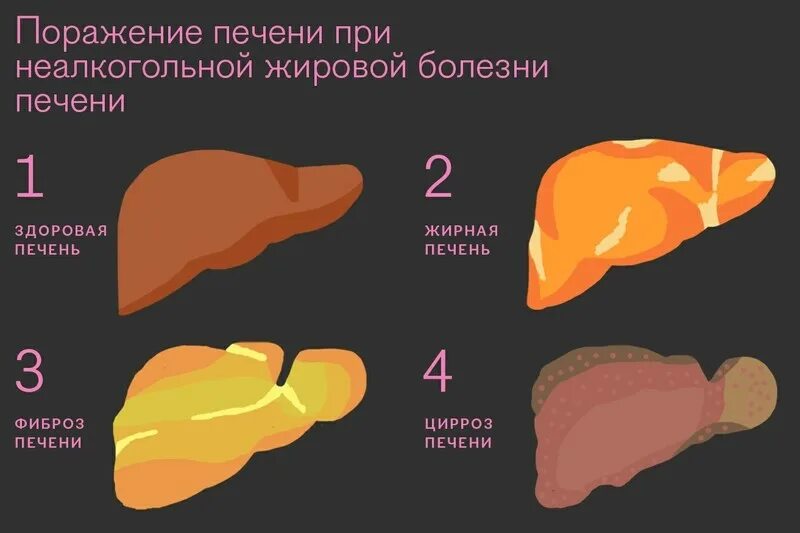 Ожирение печени фото Медицинские статьи на сайте компании Эндомедис