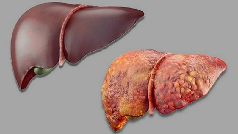 Ожирение печени фото Study Shows Artificial Intelligence Can Detect Language Problems Tied to Liver F