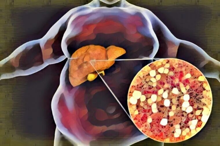Ожирение печени фото у женщин Ожирение печени: 5 продуктов, которые эффективно снижают уровень жира в печени З