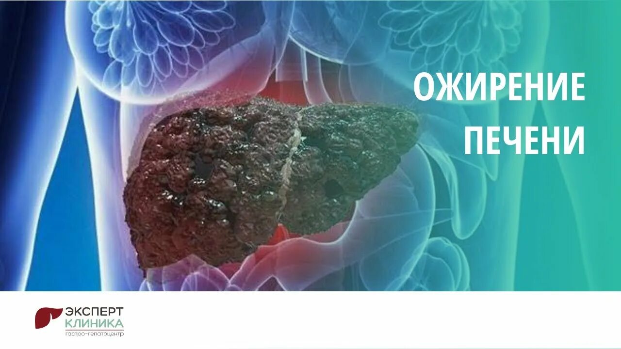 Ожирение печени фото у женщин Ожирение печени КЛИНИКА ЭКСПЕРТ - YouTube