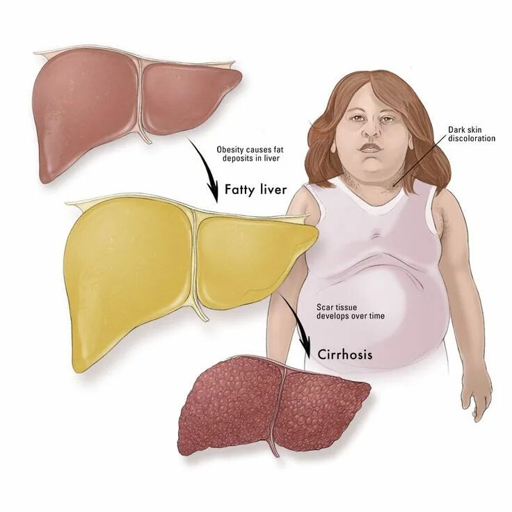 Ожирение печени фото у женщин The liver helps us do many things, from digesting our food properly to. Fatty li
