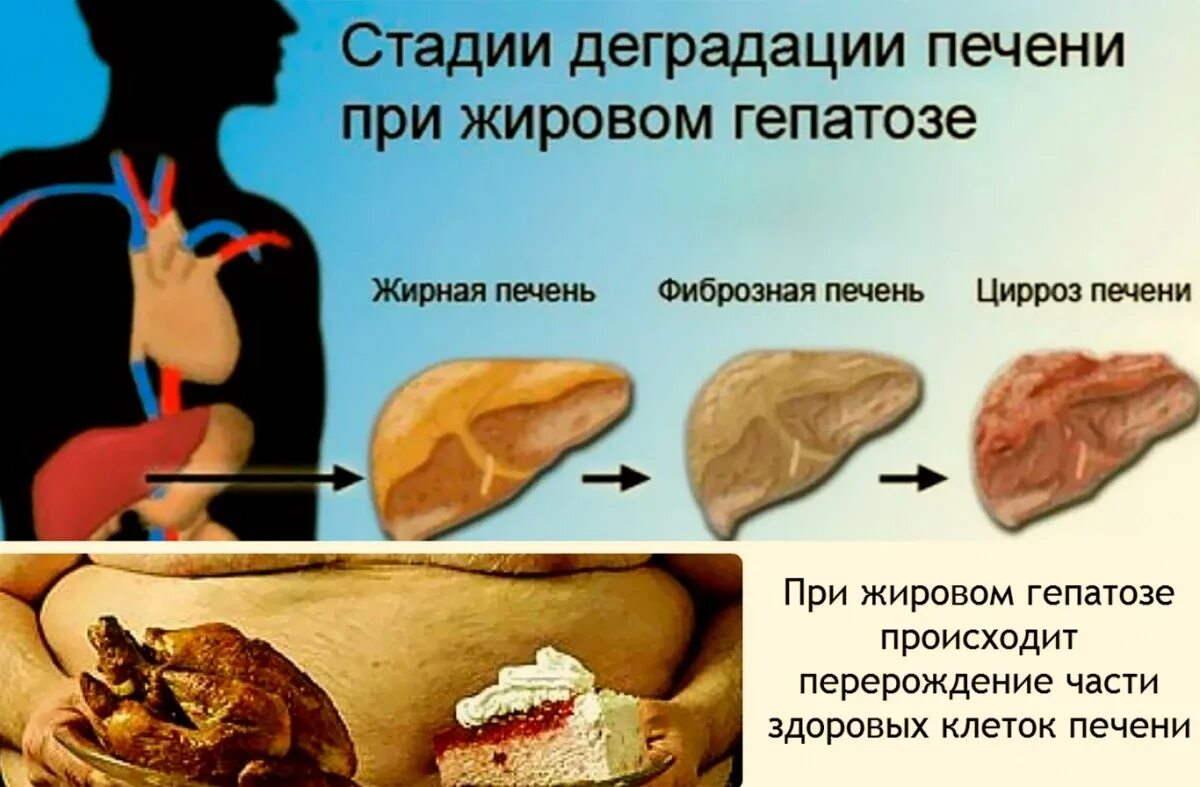 Ожирение печени фото у женщин Жировой гепатоз печени при сахарном диабете