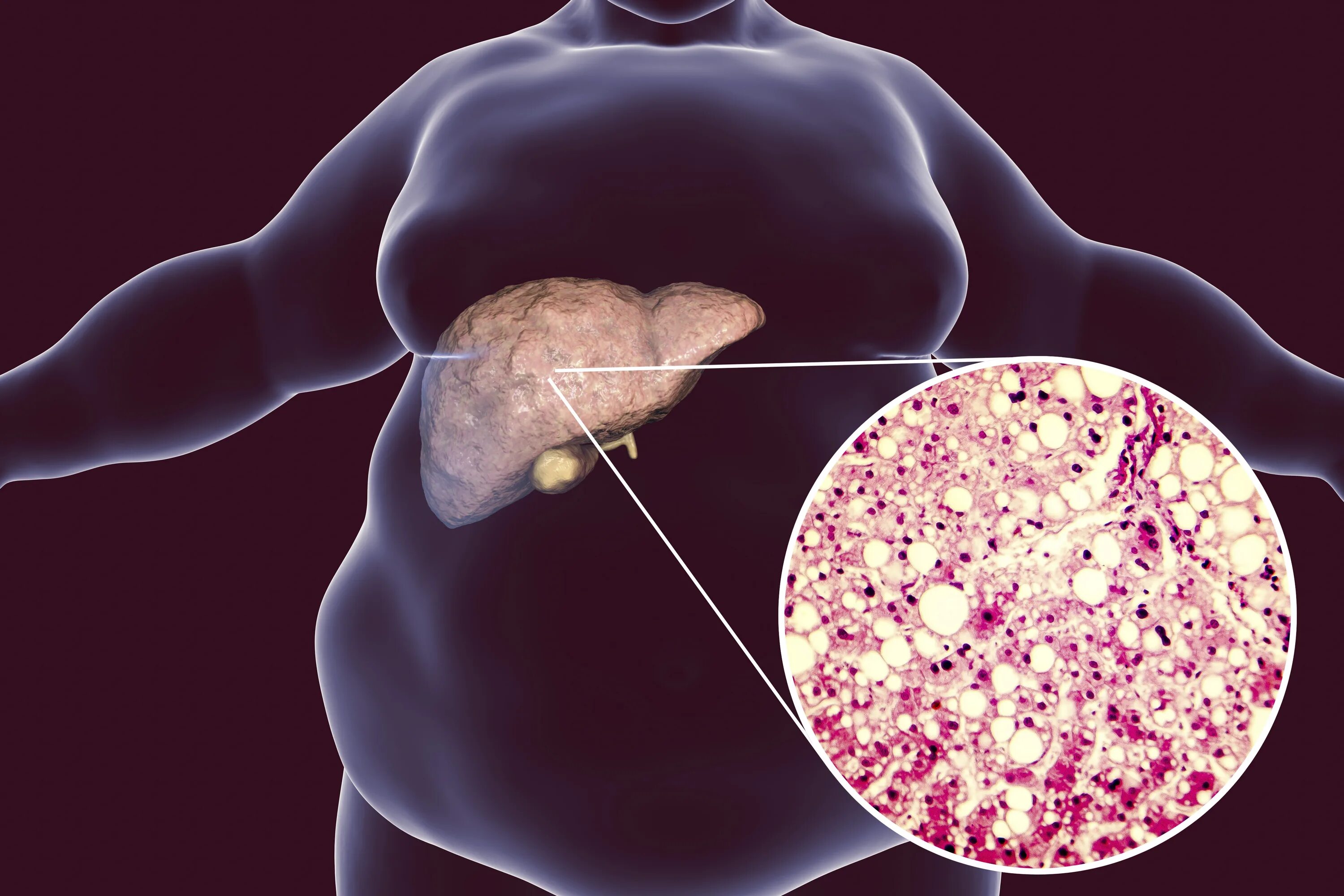 Ожирение печени фото у женщин Would An Enlarged Liver Cause Your Right Breast To Shrink Discount xn--h1aahyg1d