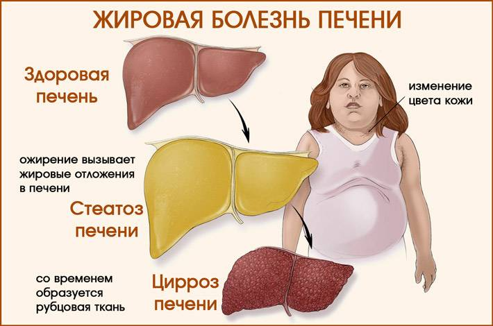 Ожирение печени фото у женщин Чем опасна "жирная печень" и всегда ли она бывает только у пьющих людей? Отвечае