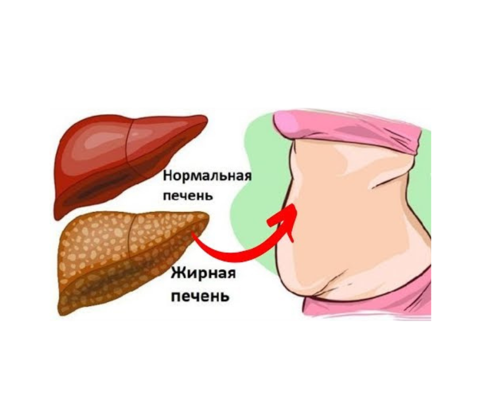 Ожирение печени фото у женщин Ожирение ПЕЧЕНИ! Даже у худых! Почему это преследует современных женщин? Как защ