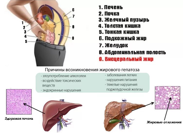 Ожирение печени фото у женщин Гепатоз жировой печени лечение у женщин симптомы: найдено 80 картинок